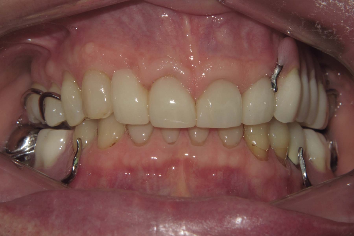 Single Tooth Removable Partial Denture